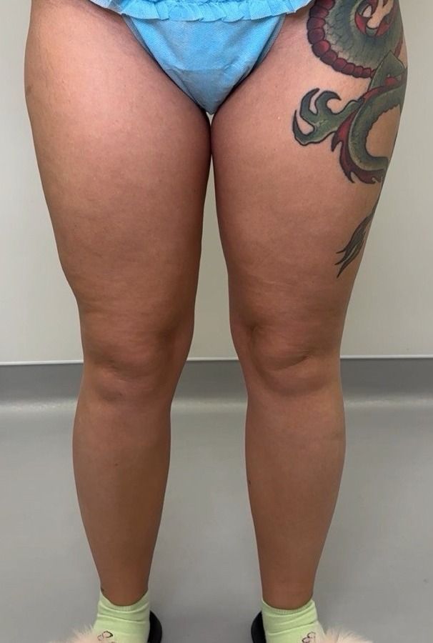 Lipedema before treatment: the patient’s legs from the front — heavy thighs and knees