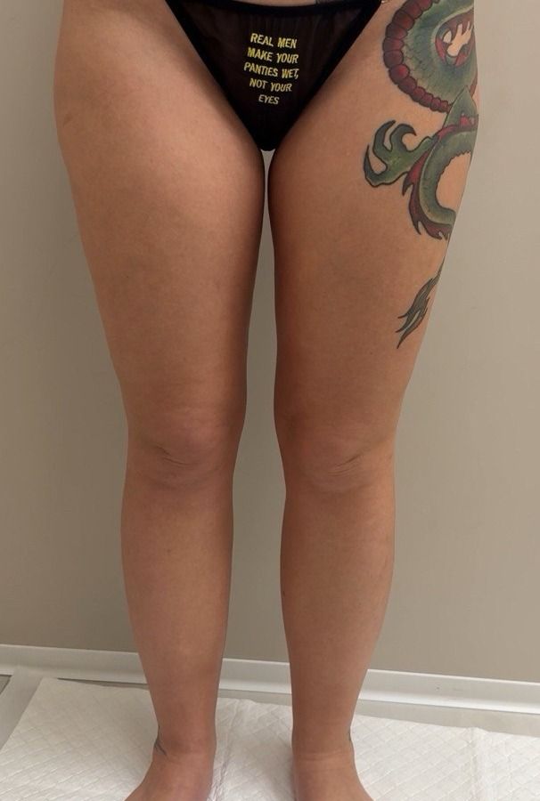 Lipedema treatment before and after: the patient’s legs from the front after surgery — slimmer thighs and knees, a smooth leg line