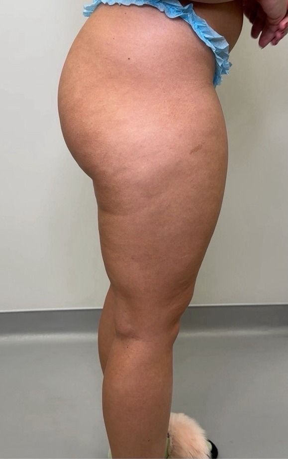 Lipedema before treatment: the patient’s legs from the side — a heavy thigh