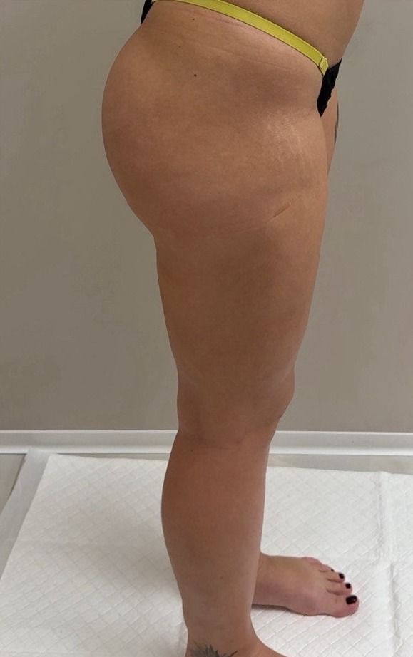 Lipedema treatment before and after: the patient’s legs from the side after surgery — a smooth thigh contour, buttock shape preserved