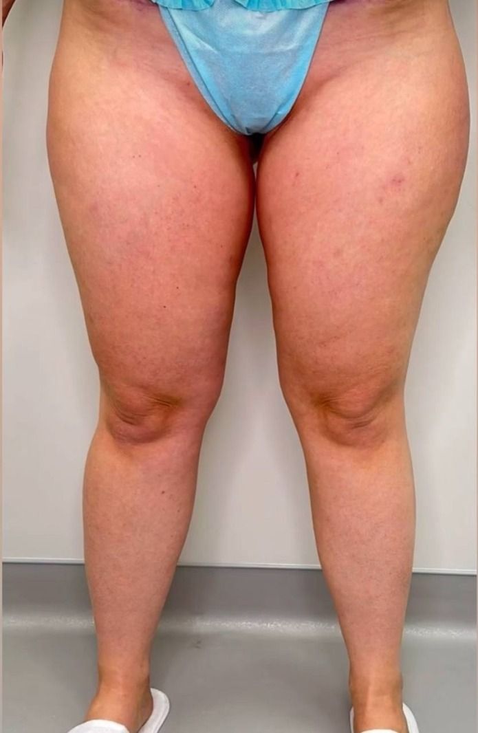 Lipedema before treatment: the patient’s legs from the front — heavy thighs and fat pads above the knees