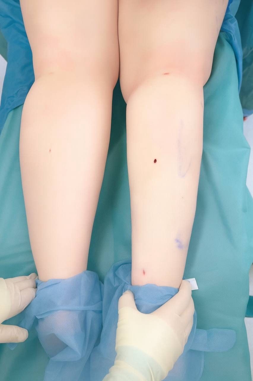 Liposuction for lipedema: small punctures on the legs at the end of surgery and marker lines